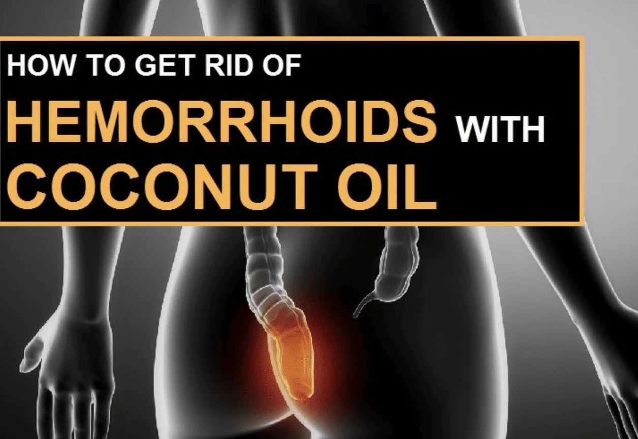 Coconut Oil for Hemorrhoids