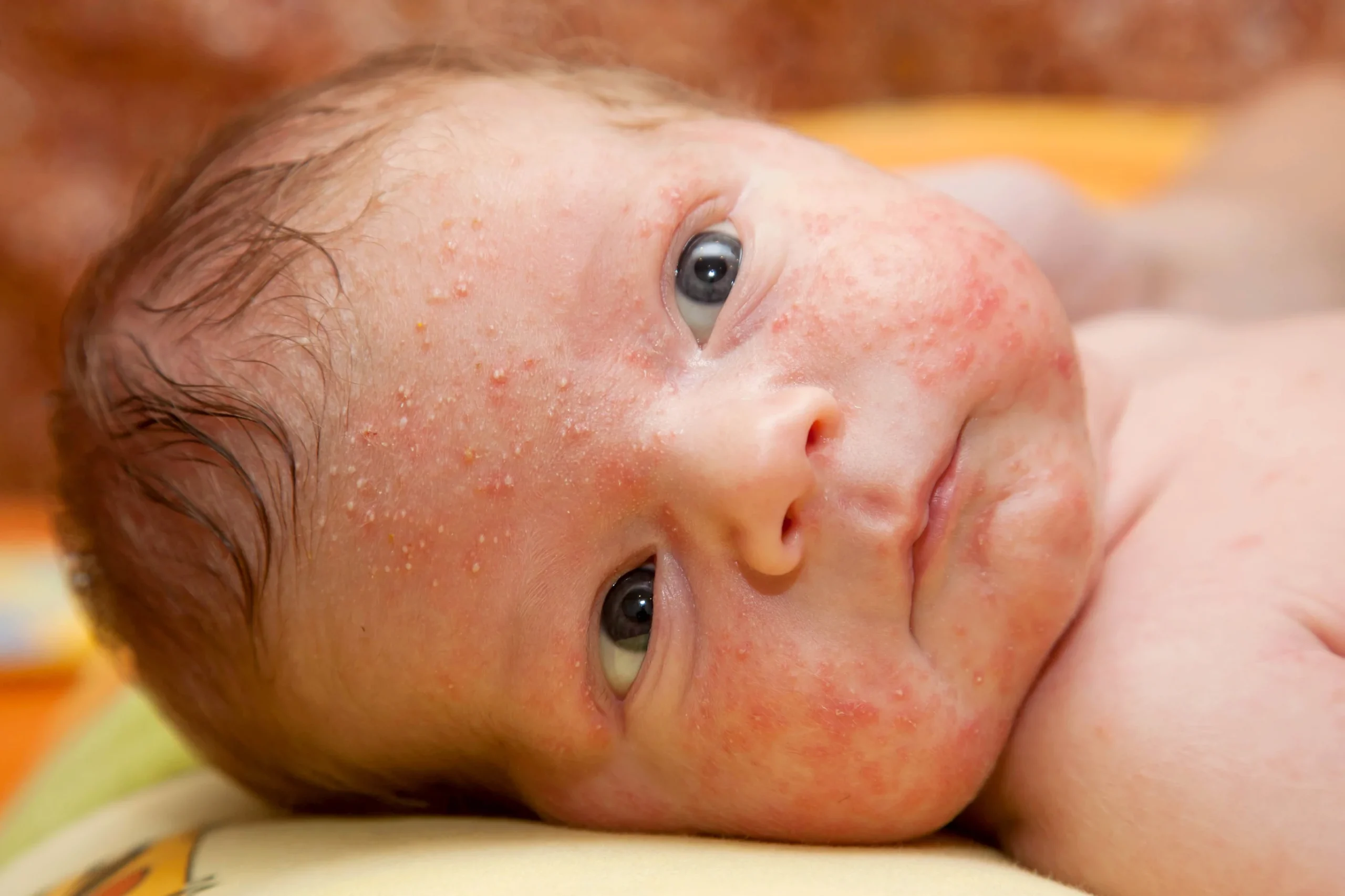 Coconut Oil For Baby Acne